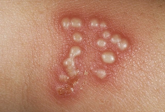 Is the treatment for mouth warts painful?